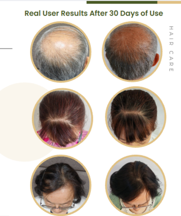 Result Prevent Hair Loss - Emophil Cedar Revita Root Active Hair Tonic Real User Results After 30 Days of Use